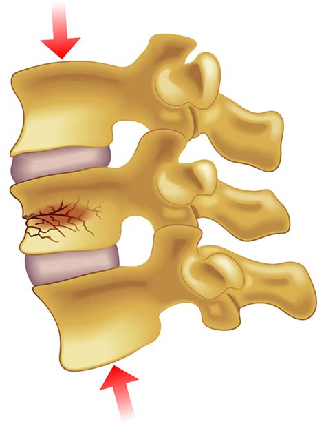 vertebrae compression test|Diagnosing Vertebral Compression Fractures .